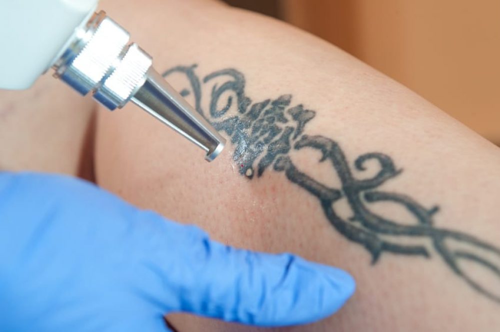 Tattoo Entfernung Rita Steinhauer Medizinische Fußpflege und Kosmetik