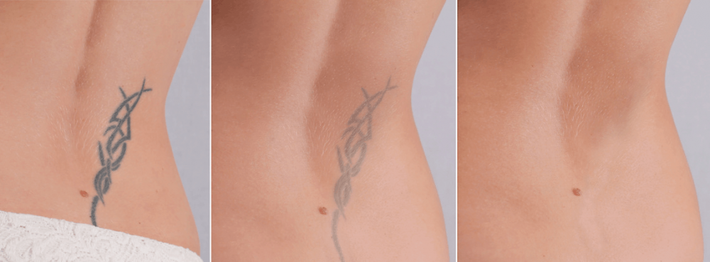 Tattoo Entfernung Rita Steinhauer Medizinische Fußpflege und Kosmetik