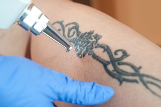 Tattoo am Bein entfernen